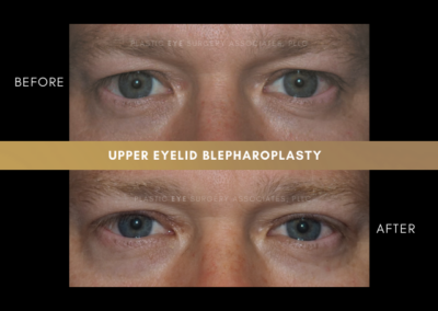 Male Blepharoplasty Photos 8
