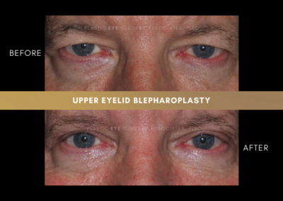 Male Blepharoplasty Photos 7