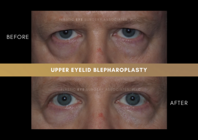 Male Blepharoplasty Photos 6