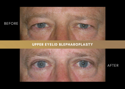 Male Blepharoplasty Photos 5