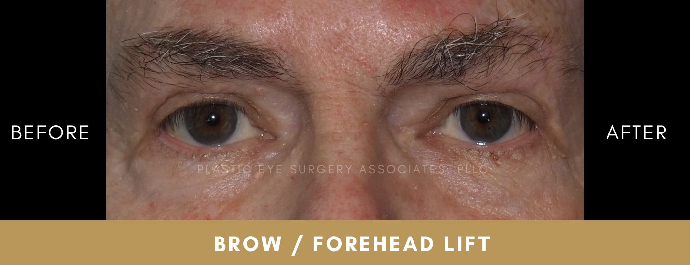 Brow / Forehead Lift 2 Brow / Forehead Lift 2