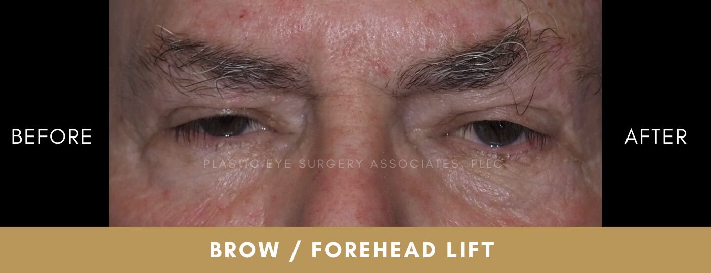Brow / Forehead Lift 1 Brow / Forehead Lift 1