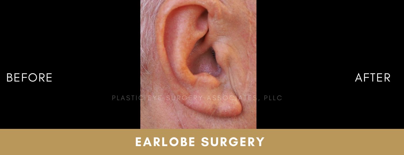 Earlobe Surgery 2 Earlobe Surgery 2