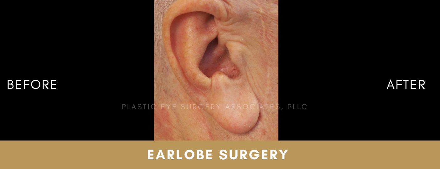 Earlobe Surgery 1 Earlobe Surgery 1