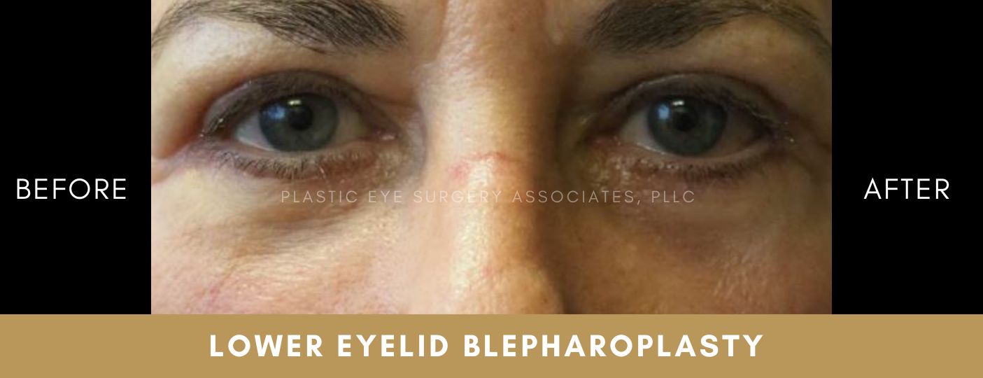 Lower Eyelid Aesthetics 2
