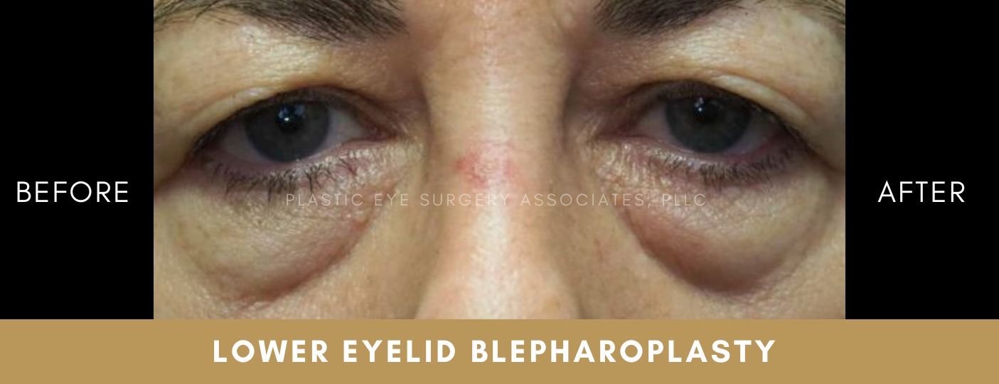 Lower Eyelid Aesthetics 1