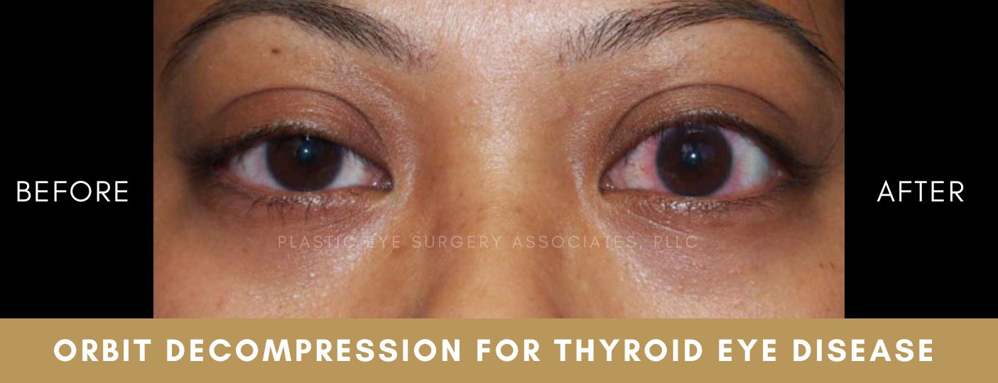 Thyroid Eye Disease 1