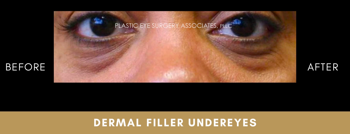 Dermal Fillers 1