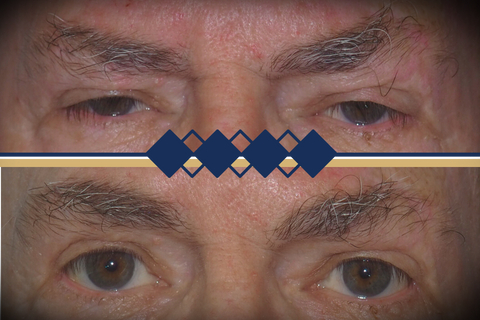Brow Lift New Img ppteam