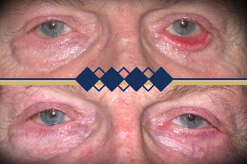 Entropion_Ectropion Reconstructive IMg ppteam