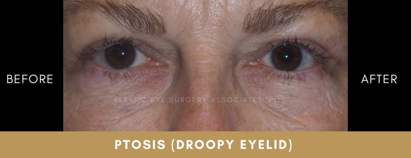 Ptosis Repair 2