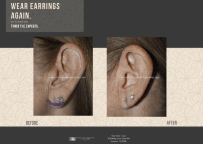 Before & After Earlobe Surgery 22