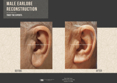 Before & After Earlobe Surgery 20