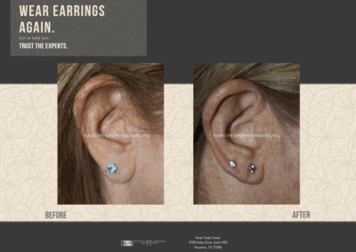 Before & After Earlobe Surgery 14