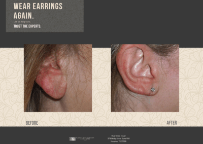 Before & After Earlobe Surgery 19