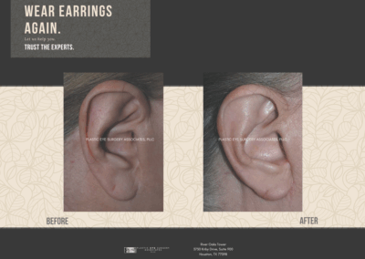 Before & After Earlobe Surgery 17