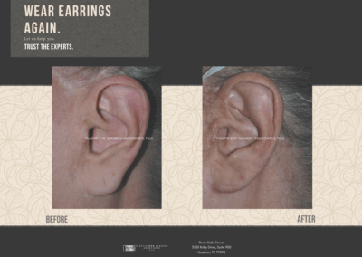 Before & After Earlobe Surgery 16