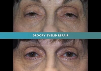 Ptosis Repair Photos 31