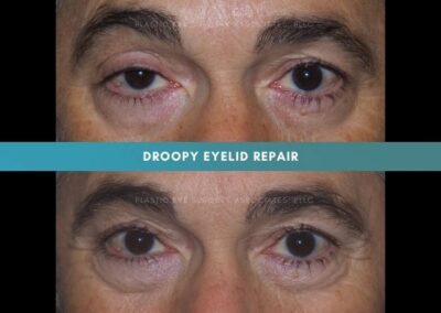Ptosis Repair Photos 33