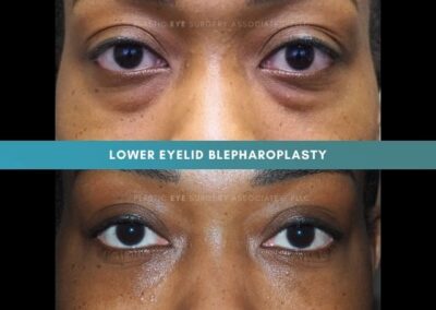 Female Blepharoplasty Photos 15