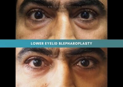 Male Blepharoplasty Photos 1