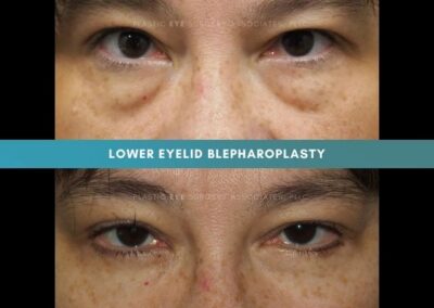 Female Blepharoplasty Photos 14