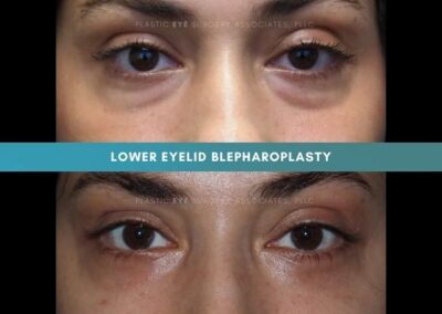 Female Blepharoplasty Photos 13