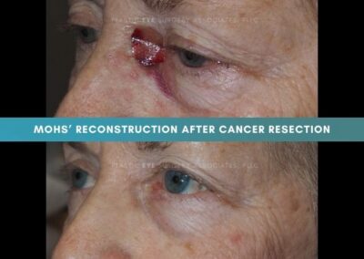 Mohs Reconstruction Photos 57