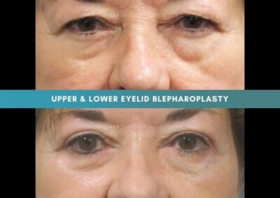 Female Blepharoplasty Photos 12