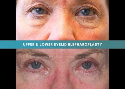 Female Blepharoplasty Photos 11