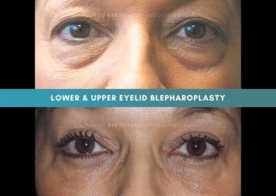 Female Blepharoplasty Photos 10