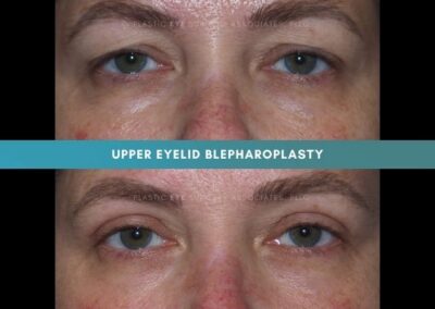 Female Blepharoplasty Photos 1