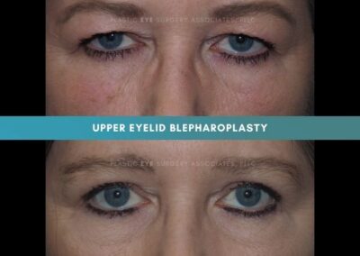 Female Blepharoplasty Photos 3