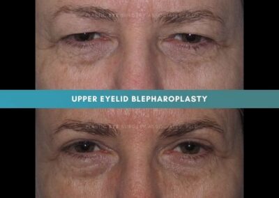 Female Blepharoplasty Photos 5
