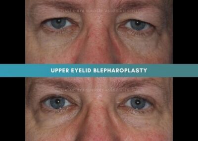 Female Blepharoplasty Photos 4
