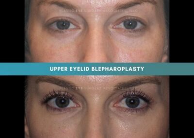 Female Blepharoplasty Photos 8
