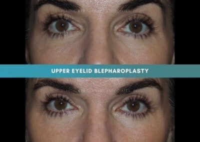 Female Blepharoplasty Photos 7
