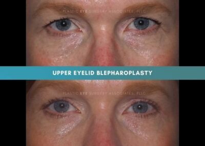 Female Blepharoplasty Photos 6
